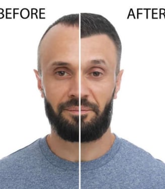 men hair patch