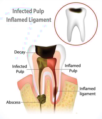 Root Canal Treatment in Navi Mumbai | Ekdantam Dental Clinic Navi Mumbai