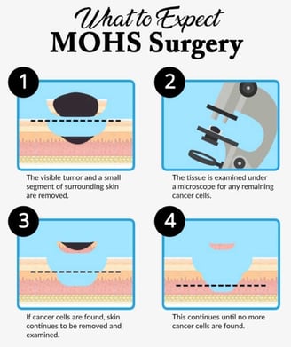 mohs-skin-cancer-surgery