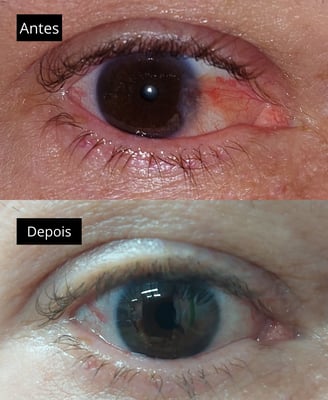 foto mostrando o antes e depois de uma cirurgia de pterigio