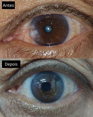 foto mostrando o antes e depois de uma cirurgia de pterigio, são paulo