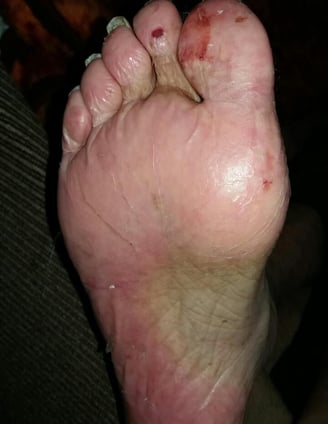 Plantar Erythrodysesthesia