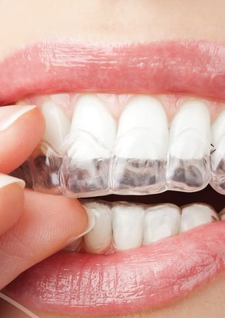 Alineadores invisibles para ortodoncia estética.  Ortodoncia invisible Dra Sors