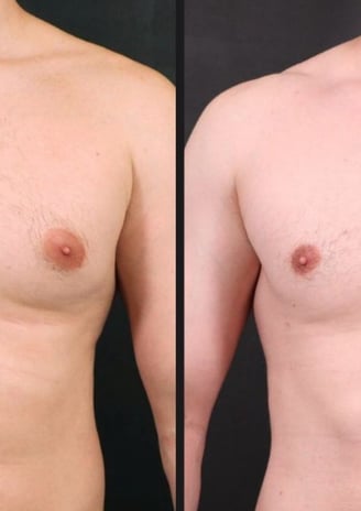 antes e depois ginecomastia 04