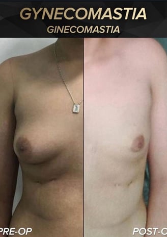 antes e depois ginecomastia 03