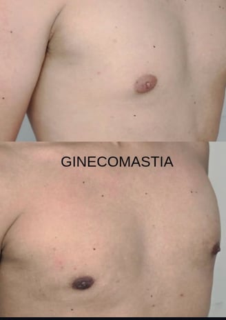 antes e depois ginecomastia 02