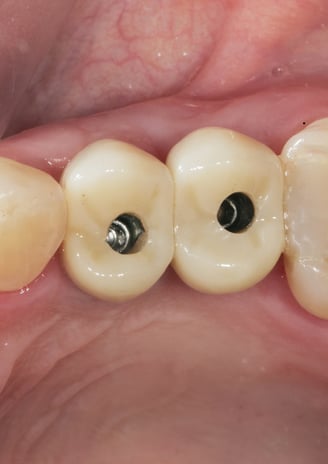 Dental crowns and bridges as restorative dental care solutions to strengthen teeth and replace missi