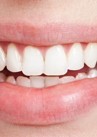 Dentist applying resin to a chipped tooth during a cosmetic bonding procedure.