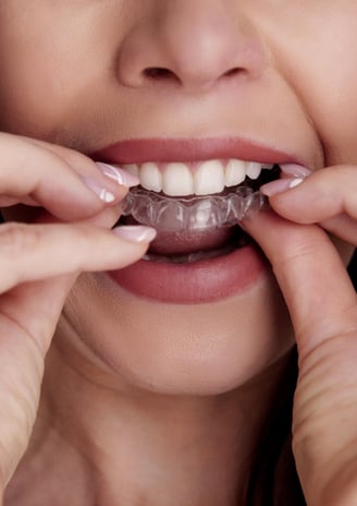 Close-up of clear aligners placed on a dental tray, showcasing their transparency and modern design