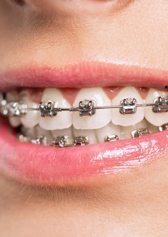 Teeth with traditional metal braces, showing durable and time-tested orthodontic care