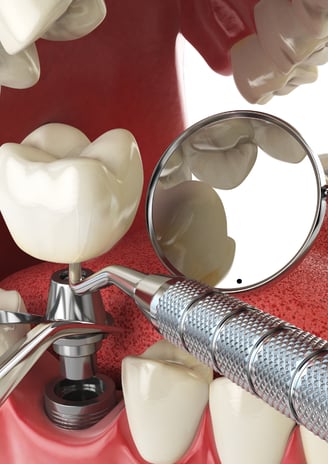 Close-up of a dental implant being placed into the jawbone during oral surgery
