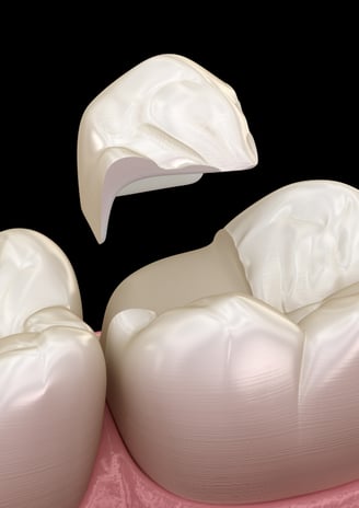 Dentist repairing a chipped tooth using dental bonding material in a clinical setting