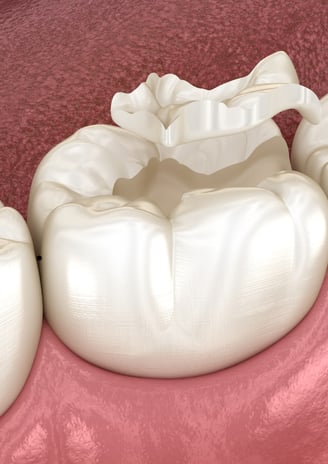 Dental professional fitting a replacement crown on a patient’s tooth after crown loss