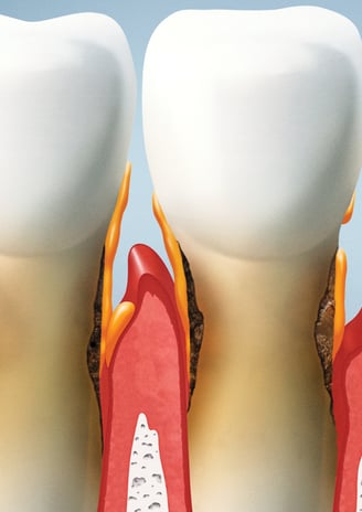 Close-up of a patient receiving professional gum disease treatment to restore oral health.