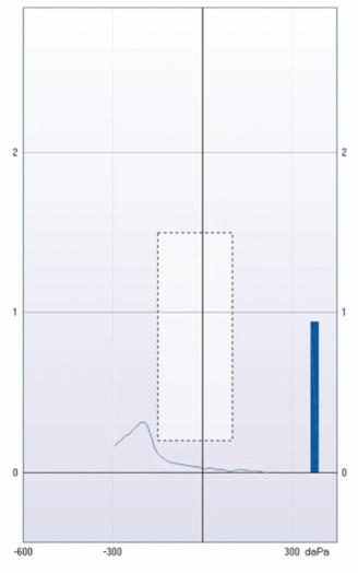 a type C tympanogram chart