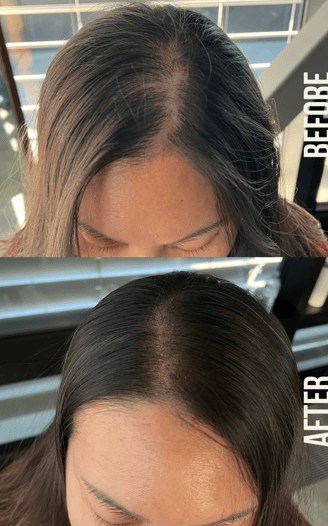 a hair density treatment on a woman with thinning hair using SMP to make her hair look thicker