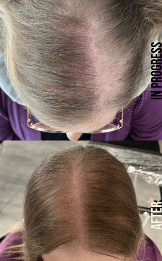 hair loss treatment on a woman with thinning hair. before and after