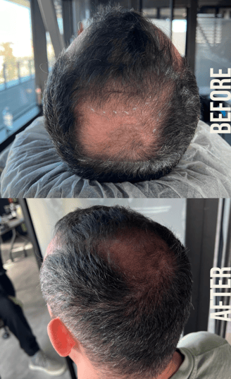 Using S&P hair loss treatment on man with bald spot before and after