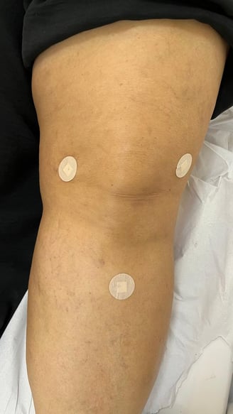 tratamento para artrose do joelho sem cirurgia