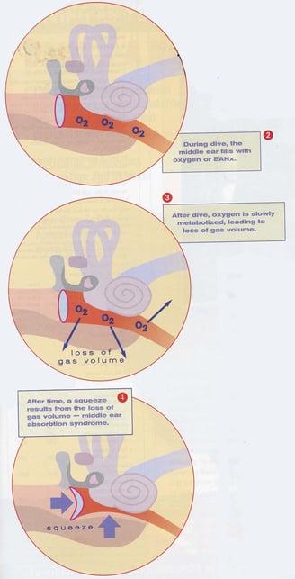 Middle Ear Oxygen Absorption