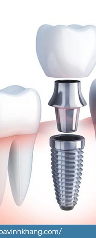 trồng răng Implant