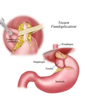 nissen fundoplication