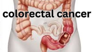 colorectal cancer