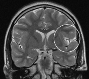 Ressonância de menino de 13 anos com epilepsia desde 2 anos com displasia fronto-insular esquerda.