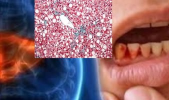 مرض الكبد الدهني اسباب النزف الخطرة
