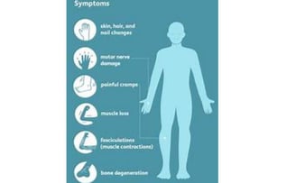 neuropathy symptoms
