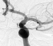 Angiografia digital perfil após a cirurgia no cérebro e clipagem do aneurisma cerebral.