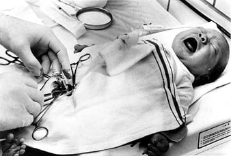 photo d'une chirurgie sur bébé sans anesthésie