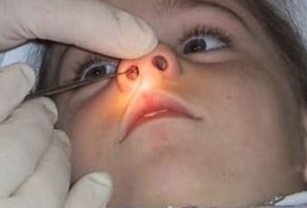 nasal f b removal