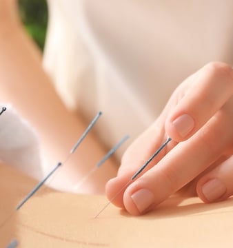 acupuntura. saúde natural. dry needling. medicina chinesa. terapias naturais. dor crônica