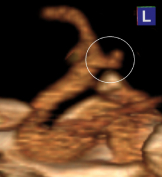 Angiotomografia perfil mostrando um aneurisma cerebral (círculo).