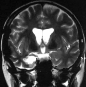 Ressonância após a cirurgia com remoção total do cavernoma temporal medial.