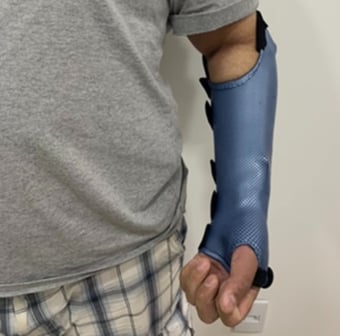 órtese para pós-operatório de fratura de rádio e ulna
