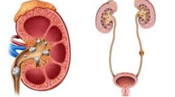 Causes and Prevention of Kidney Stones, Impacted