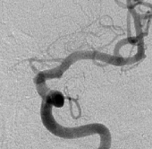 Angiografia após a cirurgia no cérebro e a clipagem do aneurisma cerebral.