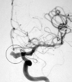 Angiografia projeção frontal evidenciando um aneurisma cerebral.