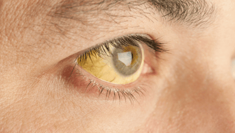 Jaundice Liver Cirrhosis