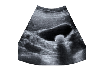 Ultrassom de abdome com cálculo na vesícula biliar