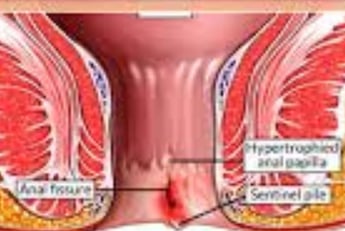 Anal fissures