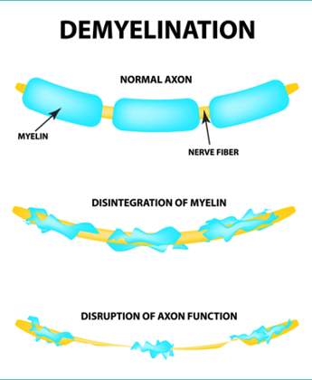Damaged nerves
