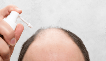 Man applying minoxidil foam to bald spot on crown area