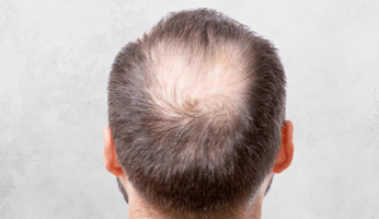 How to apply minoxidil to the scalp with dropper