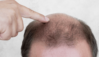 Step-by-step guide to using minoxidil for hair growth