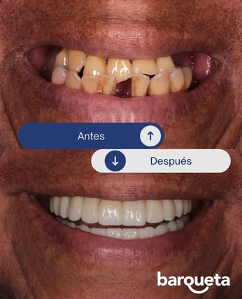 caso de exito de implantes dentales en sevilla
