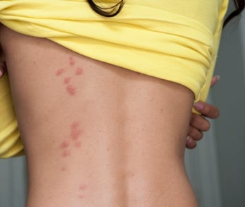 a woman's exposed back shows recent bed bug bites