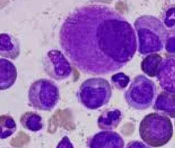 Curable Cancers And Effect Of Voluntary Fasting (4)